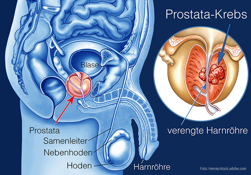Prostatakrebs-Vorsorge in der Praxis RuN Engelskirchen